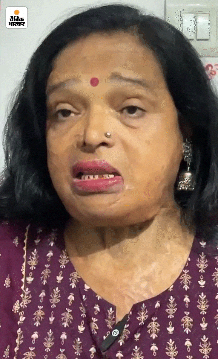 मीना बताती हैं- मेरे पति को लगता था कि मैं बहुत सुंदर हूं और जब सड़क पर चलती हूं तो लोग मुझे देखते हैं। उन्होंने एक दिन दोपहर में सोते वक्त मेरे चेहरे पर तेजाब डाल दिया।