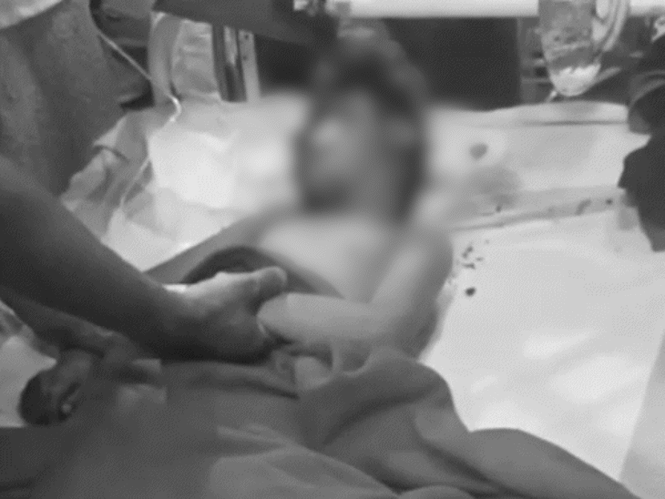 बच्चे को इंदौर के एमवाय अस्पताल में भर्ती कराया गया है।