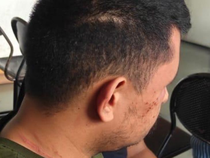 गणेश भट्ट चोट के निशान दिखाते हुए।