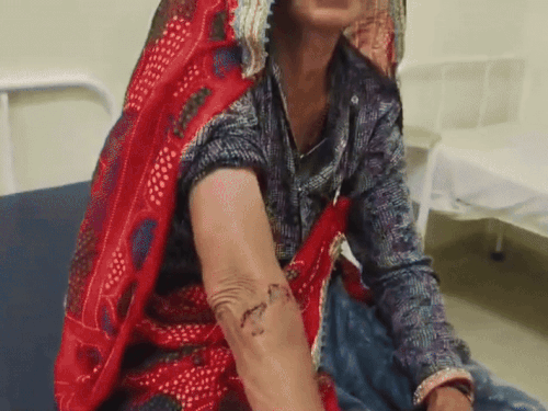 बंदरों के हमले के बाद महिला घायल हो गई, जिसका पलसाना के सरकारी हॉस्पिटल में इलाज चल रहा है।