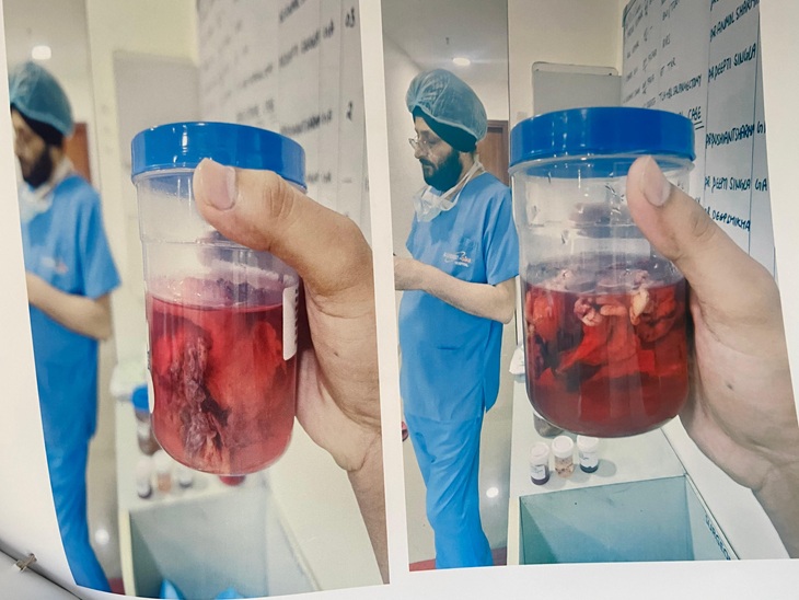 पंचकूला में ऑपरेशन के दाैरान महिला के गर्भ से निकली पट्‌टी।