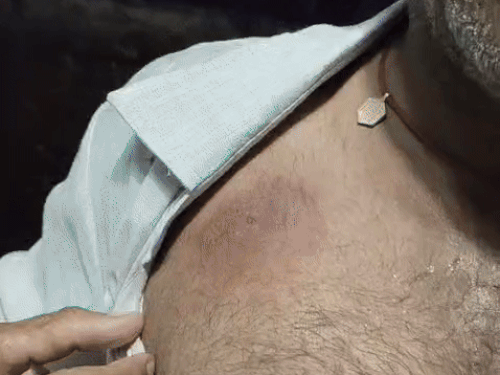Villagers showing complaints of allergy on chest in sugar mandouri