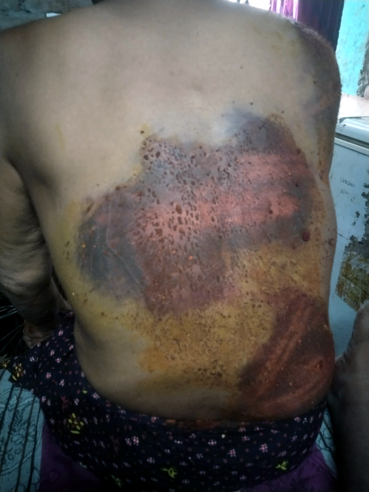 पलामू में श्मशान घाट पर तंत्र-मंत्र करने का आरोप:  73 वर्षीय बुजुर्ग समेत दो महिलाओं की पिटाई, एक की हालत नाजुक – Palamu News