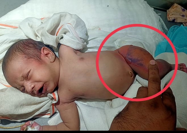 The child is admitted to Bhilwara District Hospital, whose condition remains critical. The skin of one leg burned with hot stones.