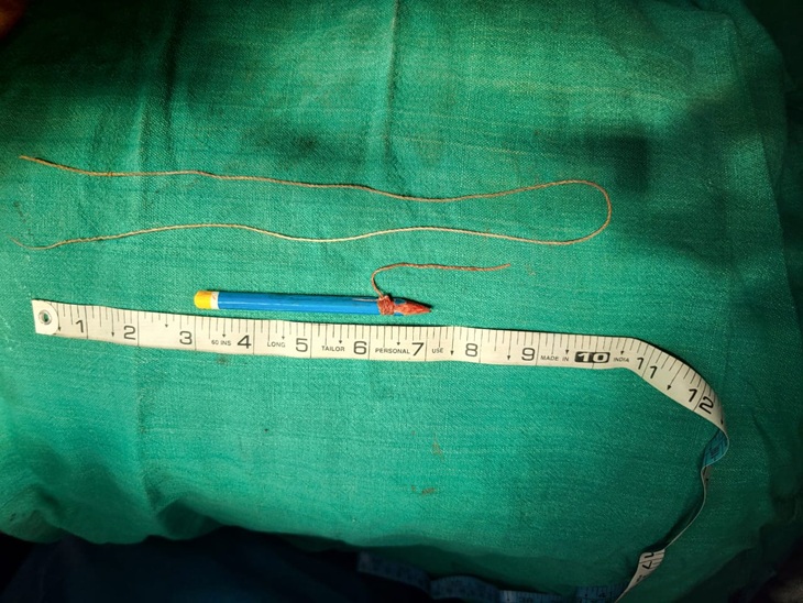 बंदी के पेशाब नली से निकाला गया पेंसिल।