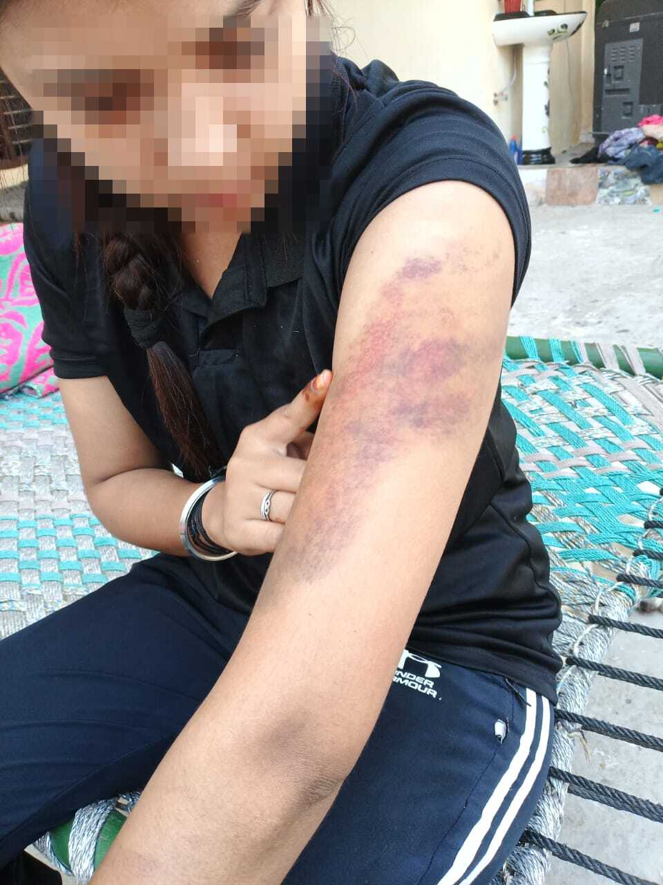 चोट के निशान दिखाते हुए प्रीति कौर।