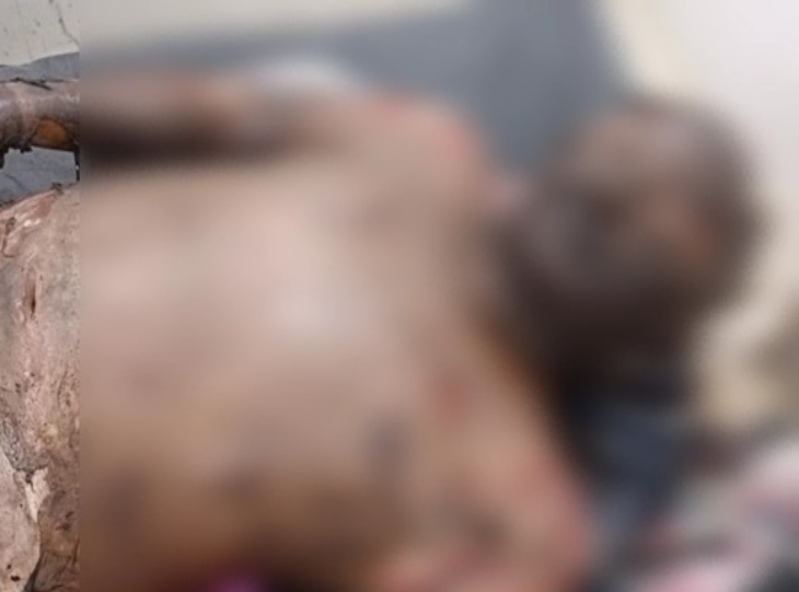 पति सुपारी लाल का पूरा शरीर आग से बुरी तरह झुलस गया था।