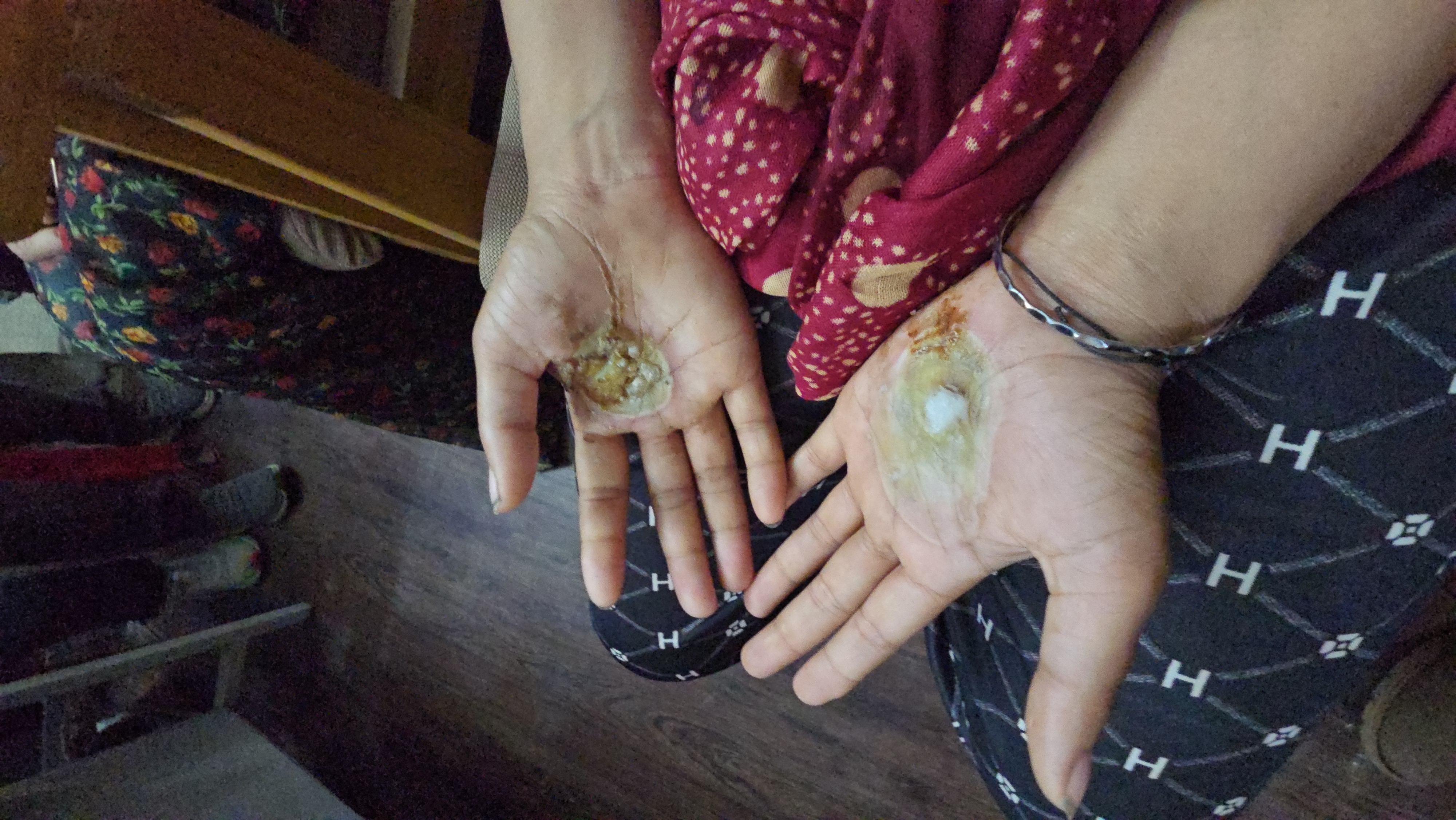 अपने जले हुए हाथ दिखाती महिला।