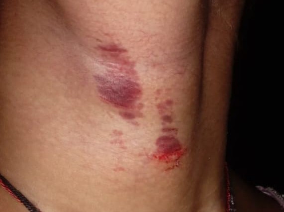 आरोपी से खुद को बचाने की कोशिश करते हुए किशोरी के गले में खरोच आई थी।