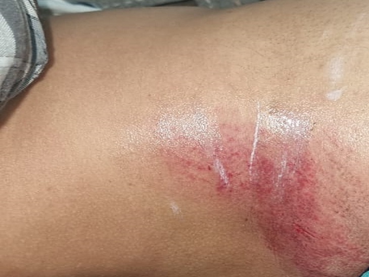 वनकर्मी को लगी चौट।