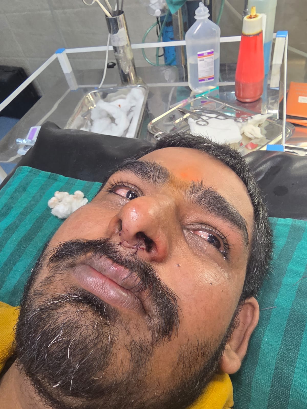 चाइनीज मांझा से पंडित आदर्श तिवारी की नाक कट गई।