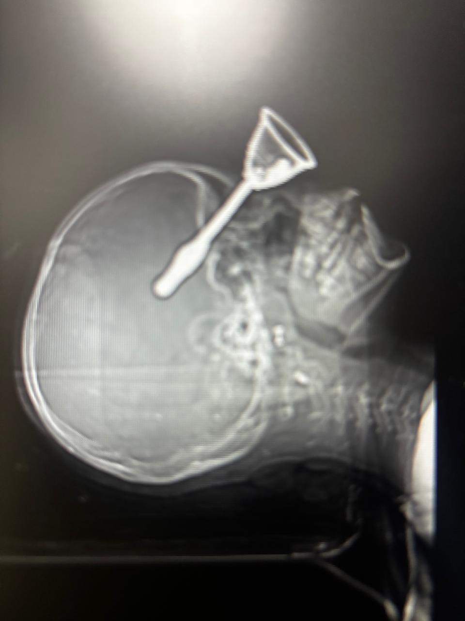 Raipur DKS Hospital Surgery: रायपुर के DKS अस्पताल में डॉक्टरों ने किया चमत्कार, 9 साल की बच्ची की आंख से दिमाग में घुसी घंटी, निकालकर बचाई जान Raipur DKS Hospital Surgery: रायपुर के DKS अस्पताल में डॉक्टरों ने किया चमत्कार, 9 साल की बच्ची की आंख से दिमाग में घुसी घंटी, निकालकर बचाई जान