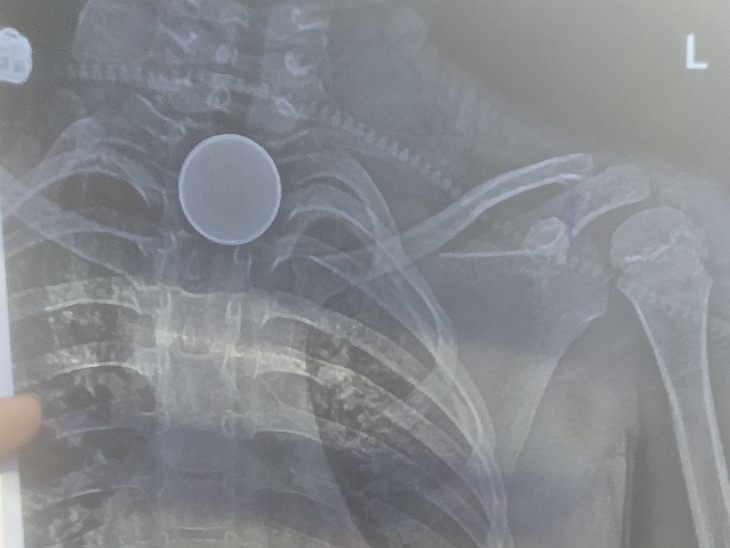 एक्स-रे रिपोर्ट में सीने में सिक्के के फंसने की पुष्टि हुई थी।