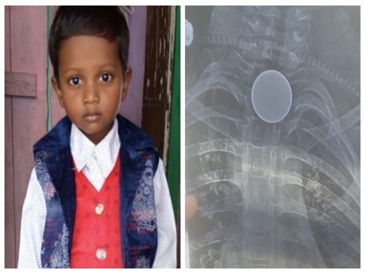 डॉक्टरों का कहना है- सीने में कुछ सिक्का नुमा चीज फंसा था।