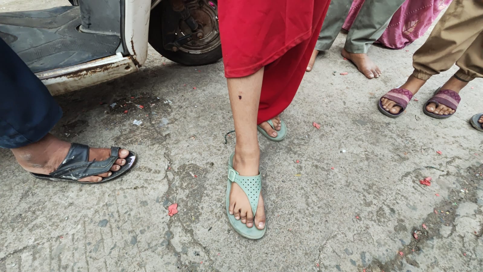 कुत्ते के हमले में घायल एक युवती अपना जख्म दिखाई हुई।