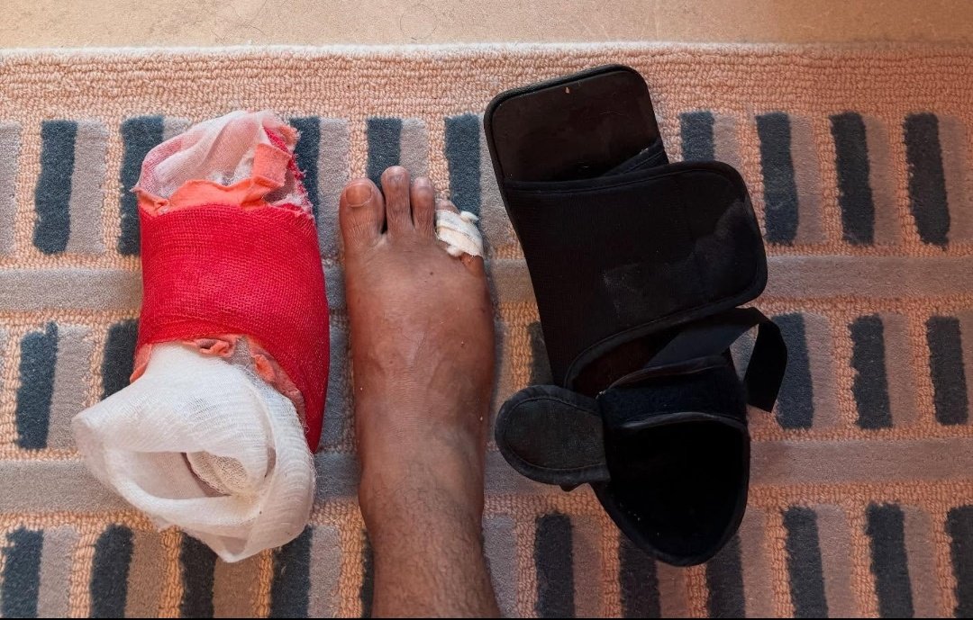 इंग्लैंड सीरीज के दौरान ऋषभ पंत के पैर की 2 उंगलियों में चोट लगी थी।