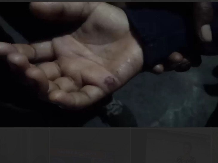 हादसे में बच्चे के हाथ में लगी चोट।
