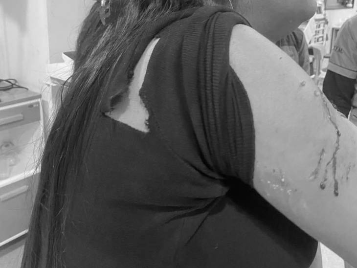 घायल महिला को परिवार के लोग हॉस्पिटल लेकर गए। प्राथमिक इलाज के बाद उसे हॉस्पिटल से छुट्टी दे दी गई।