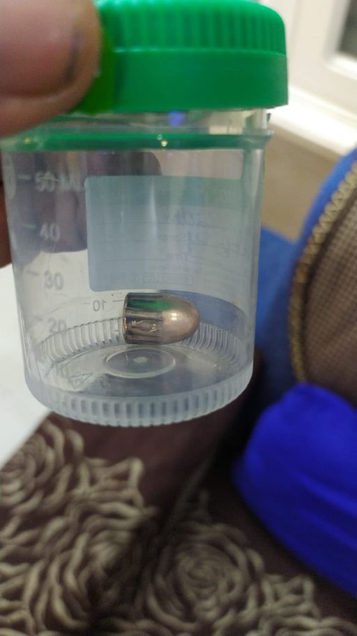 अमृतसर में बच्ची की टांग से निकली गोली। (फाइल फोटो)