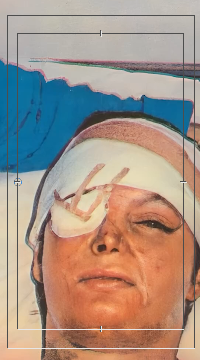 एसिड के कारण बर्गेन की एक आंख खराब हो गई थी।