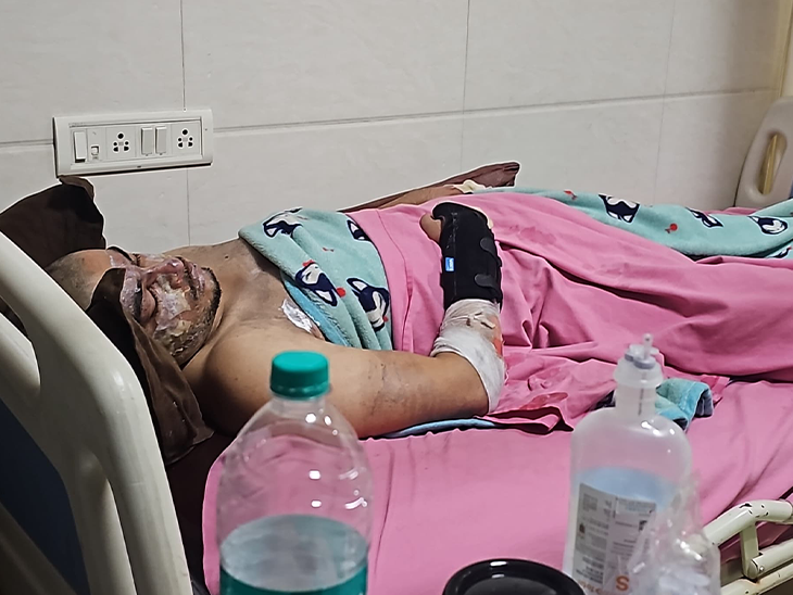 युवक की हालत नाजुक बताई जा रही है। उसका चेहरा और हाथ बुरी तरह झुलस गया है।
