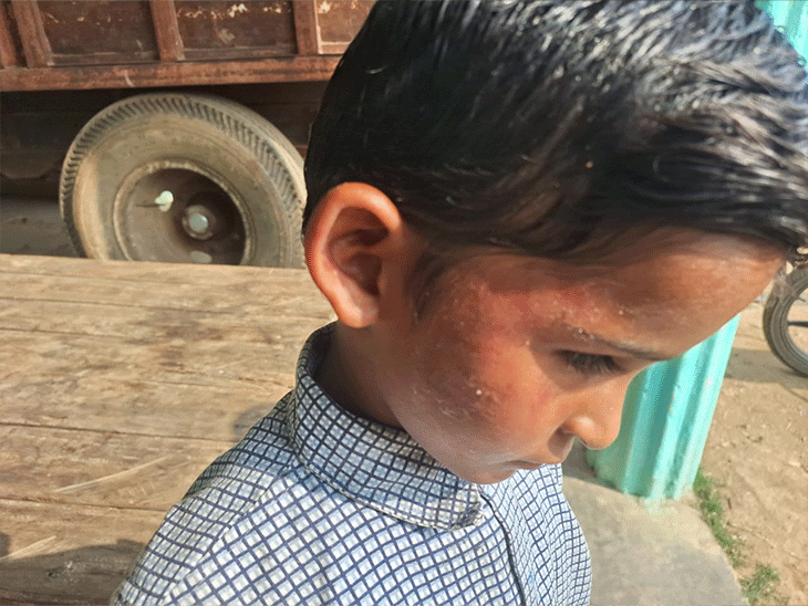 बलरामपुर जिले में गिनती नहीं सुना पाने पर शिक्षक ने बच्चे को पीटा। - Dainik Bhaskar