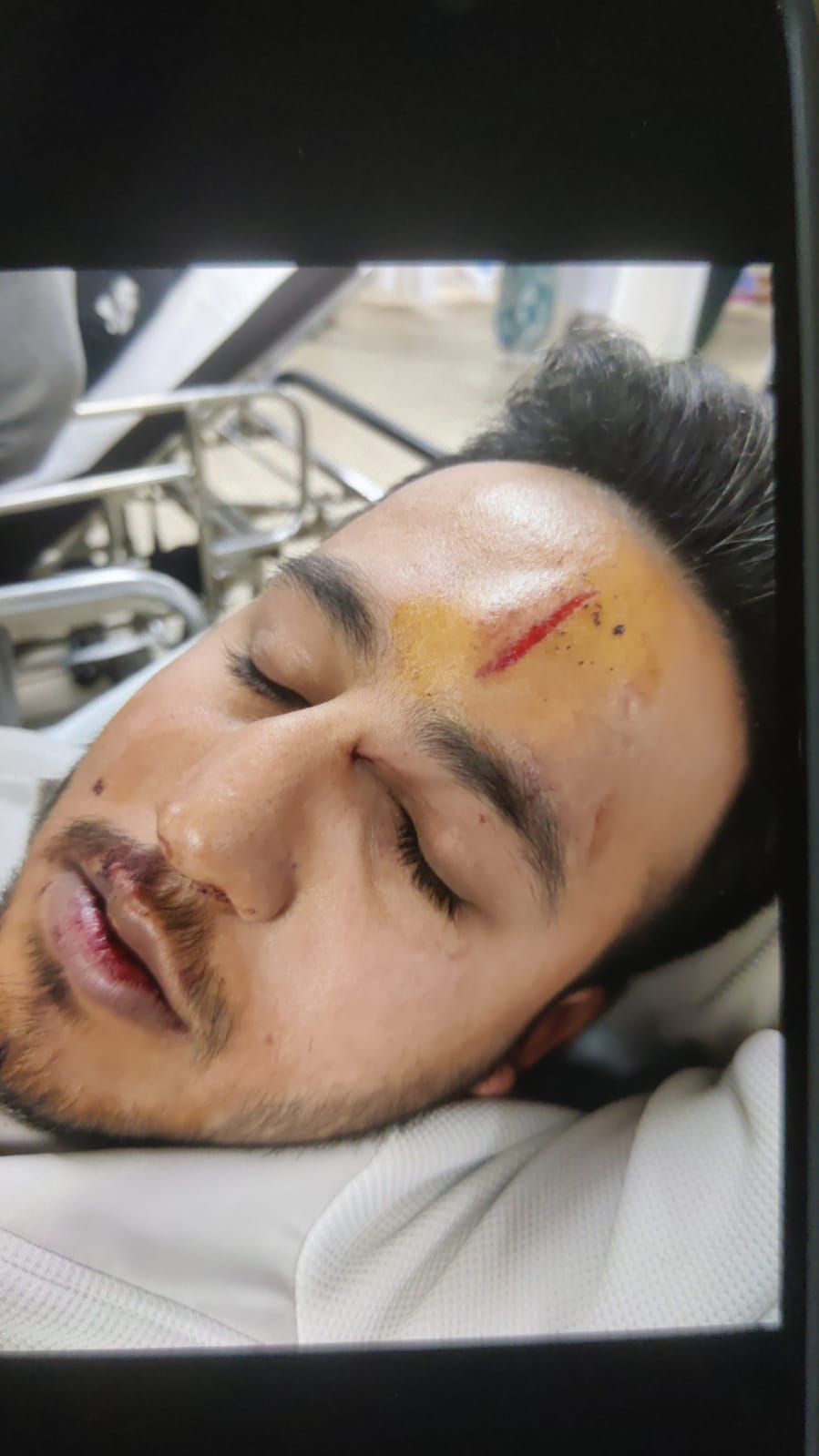 लुधियाना में धारदार हथियारों से हमला:  लापता बहन को ढूंढने गए भाई और रिश्तेदारों को पीटा,नाक की हड्डी तोड़ी – Ludhiana News