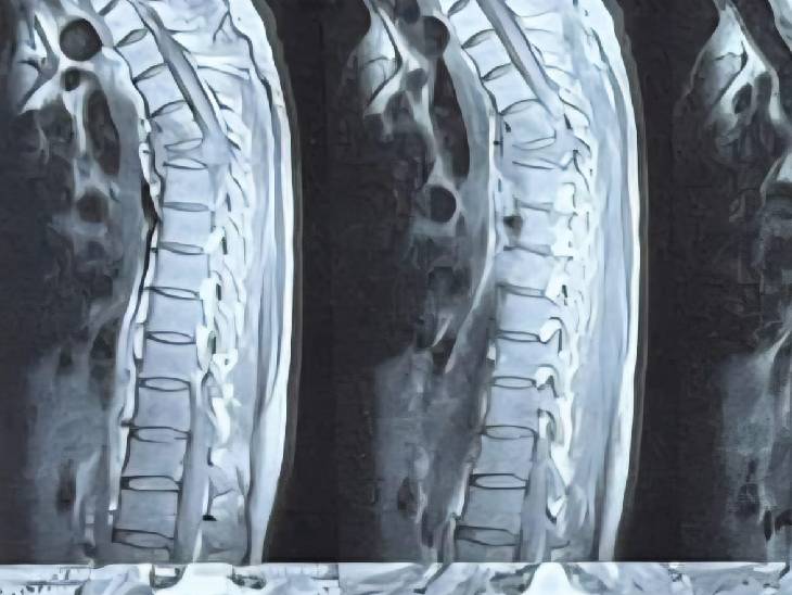 कैंसर के कारण रीढ़ की हड्‌डी टूट गई थी।