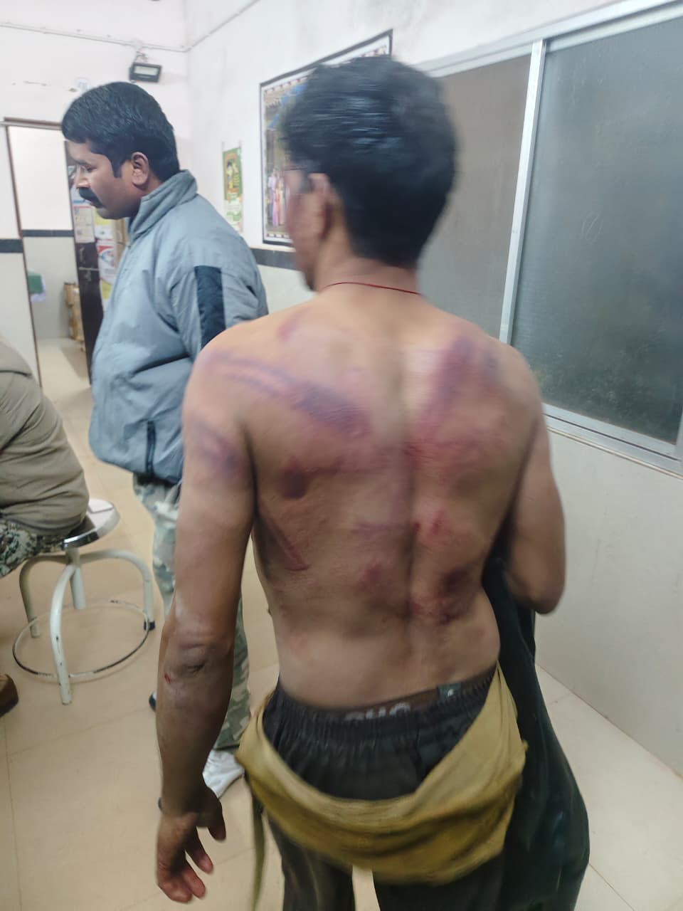 युवक के शरीर पर दिख रहे जख्म के निशान। पीठ पर बेल्ट से पीटने के निशा हैं।