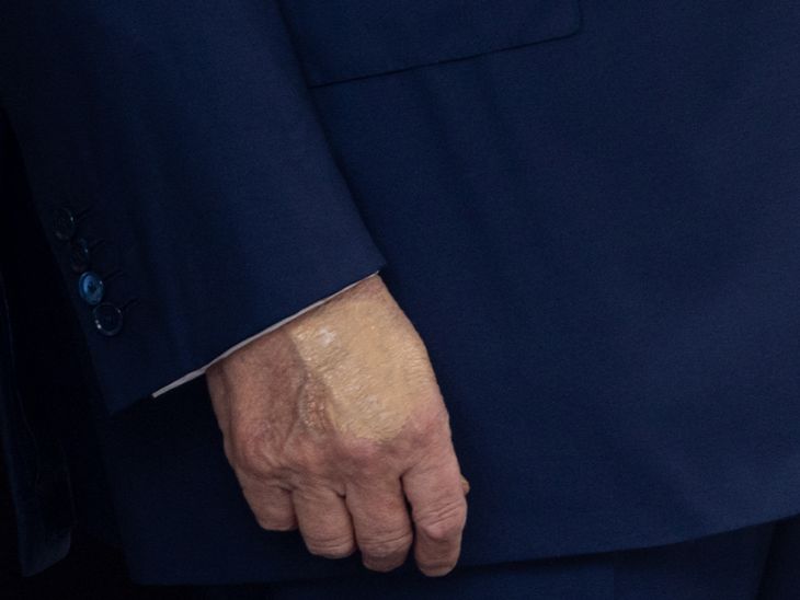 ट्रम्प के दाहिने हाथ पर चोट का निशान दिखा था, जो मेकअप से ढका हुआ लग रहा था।