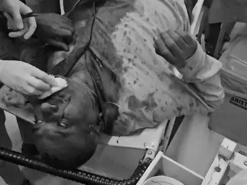 पथराव और गुलेल से हमले में अधिकांश लोगों के सिर में चोटें आई हैं।