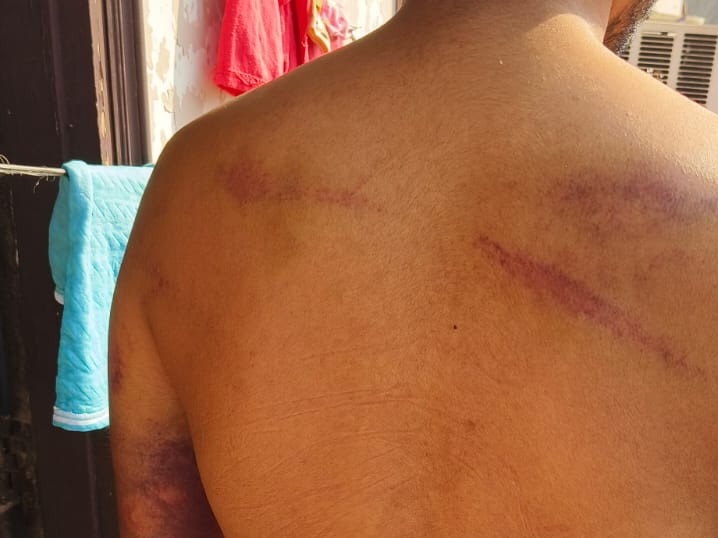 हमलावरों की पिटाई से युवक की कमर पर पड़े निशान।