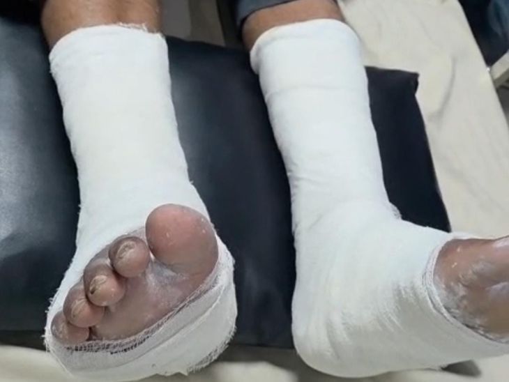 राजू के दोनों पैरों में प्लास्टर चढ़ा है। उसे काफी चोट लगी है।