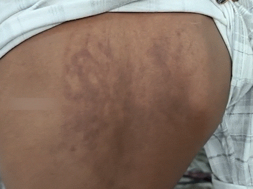 छात्र के शरीर पर गंभीर चोट के निशान दिखाती उसकी मां।