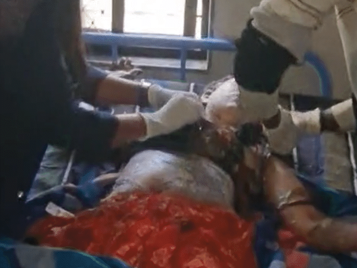 खुद को आग लगाने के बाद पति-पत्नी गंभीर रूप से झुलस गए।