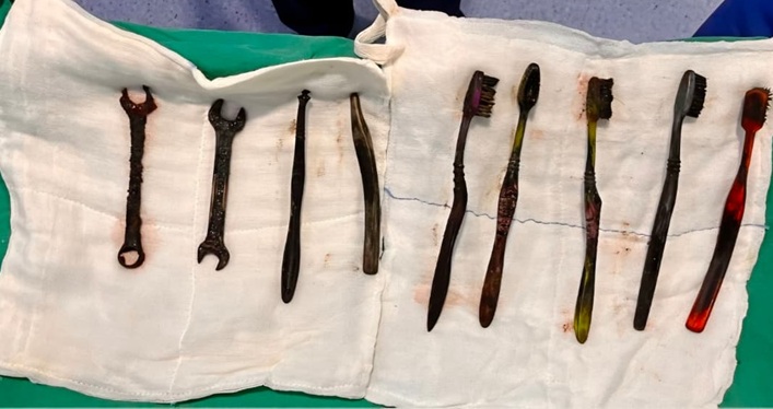 ऑपरेशन के बाद पेट से निकाली गई वस्तुएं।