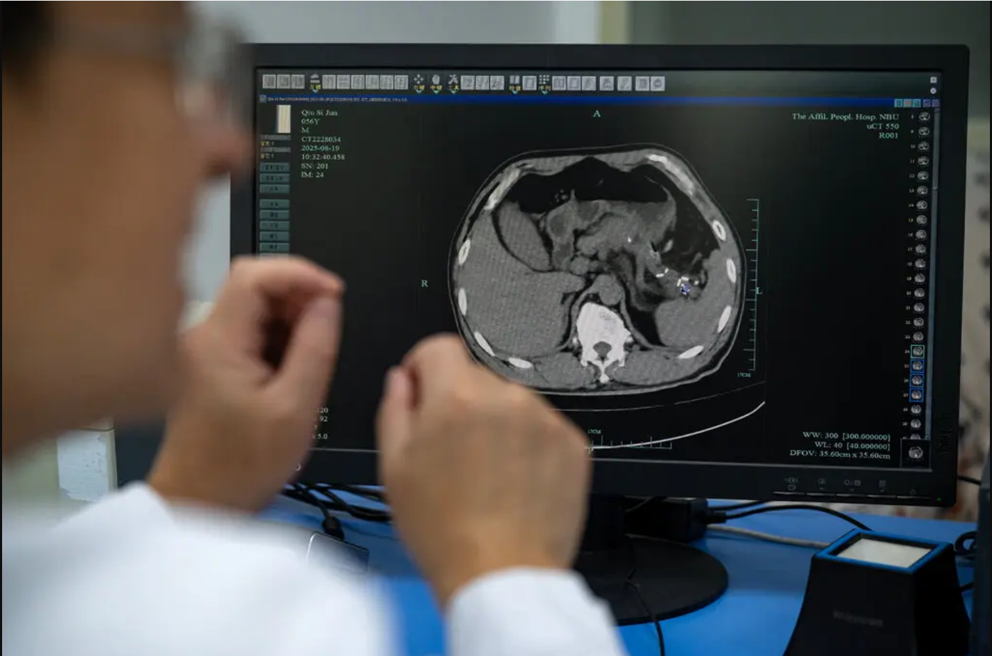 चीनी AI टूल ऐसे CT स्कैन में भी कैंसर के लक्षण ढूंढ लेता है, जिसे कई बार डॉक्टर नजरअंदाज कर देते हैं।