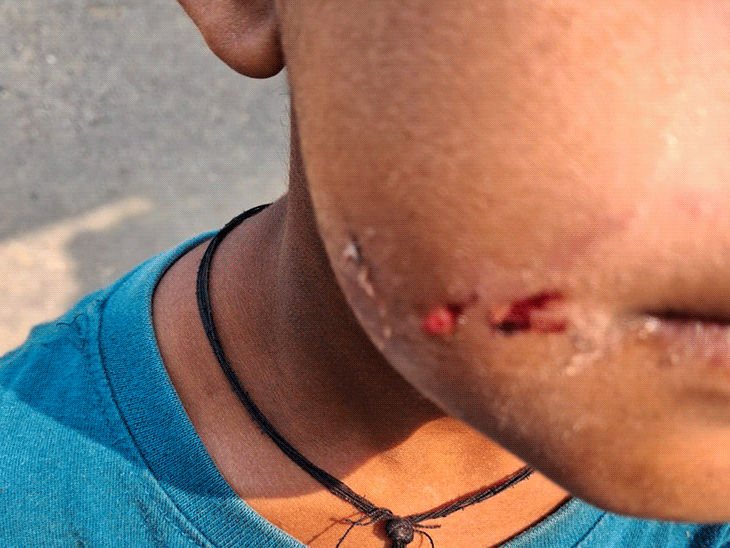 छत्तीसगढ़ के बिलासपुर में आवारा कुत्ता स्कूल में घुस आया। पहली कक्षा के छात्र को काट दिया। - Dainik Bhaskar