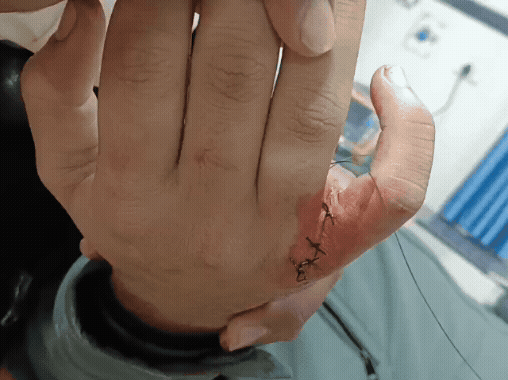 चाइनीज मांझे से की वजह से एक बच्चे की उंगली बुरी तरह कट गई।