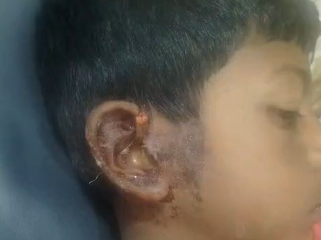 घर से बाहर खेल रहा अथर्व चाइनीज मांझे की चपेट में आ गया।
