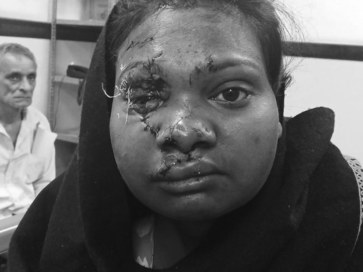 युवती गंभीर रूप से घायल हुई थी। उसके चेहरे में आंख और होंठ कट गए थे।