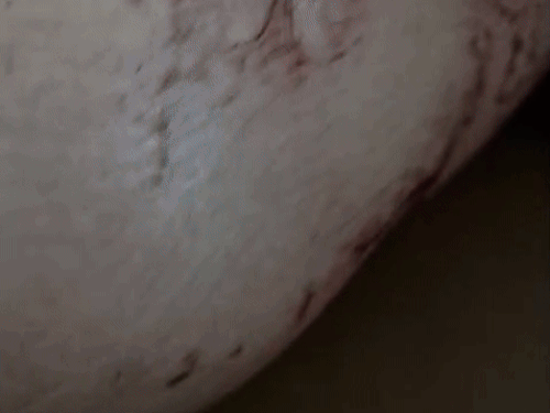 तिलक नगर में युवक पर चाकू से हमला:  18 बार वार करके छाती, पेट सहित कई जगह घायल किया, दो आरोपियों में एक की पहचान – Bikaner News