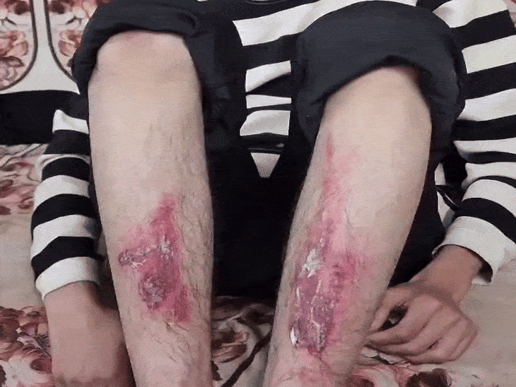 अबान द्वारा पीटे जाने के बाद छात्र के पांव की हालत ऐसी हो गई थी।