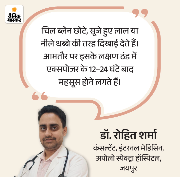 Winter Finger Inflammation Reason; Chilblains Symptoms & Risk Factors 13 zkk in winter the fingers become swollen 18 01 202 1768478834 -