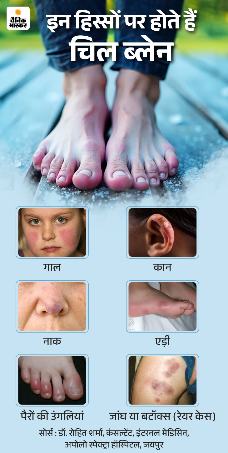 Winter Finger Inflammation Reason; Chilblains Symptoms & Risk Factors 14 zkk in winter the fingers become swollen 18 01 202 1768478871 -