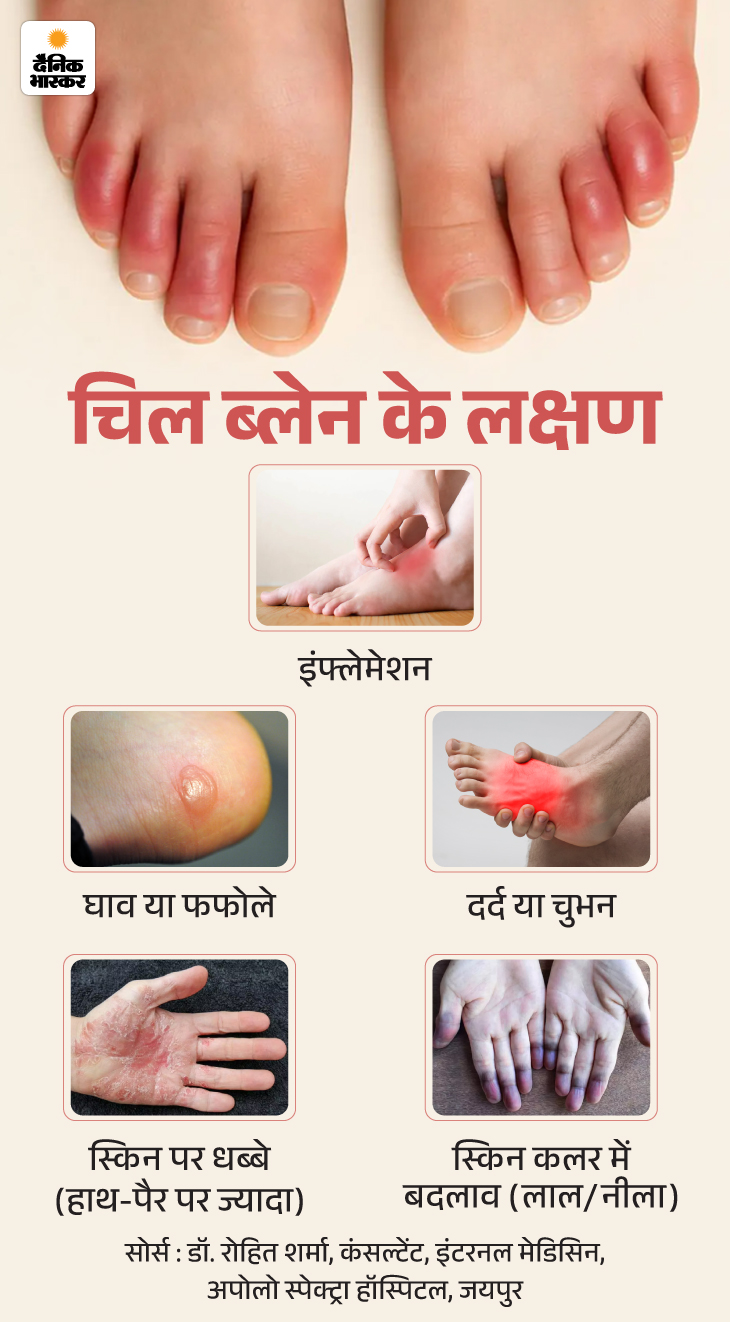 Winter Finger Inflammation Reason; Chilblains Symptoms & Risk Factors 15 zkk in winter the fingers become swollen 18 01 202 1768478908 -