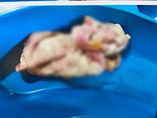 पंचकूला में महिला पेशेंट के गर्भ से ऑपरेशन कर निकाली गई पट्‌टी।