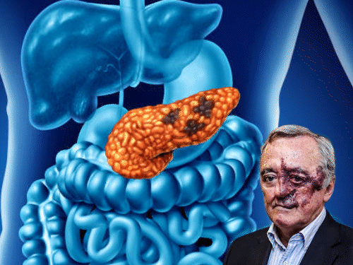 पैंक्रियाटिक कैंसर के 90% मरीज 5 साल भी नहीं जी पाते हैं। (इनसेट- रिसर्च टीम को लीड करने वाले वैज्ञानिक मारियानो बार्बासिड) - Dainik Bhaskar