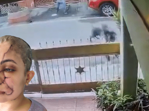 बेंगलुरु में पालतू कुत्ते का महिला पर हमला, VIDEO:  चेहरे-गर्दन पर काटा, 50 से ज्यादा टांके आए; बचाने आए युवक पर भी झपटा