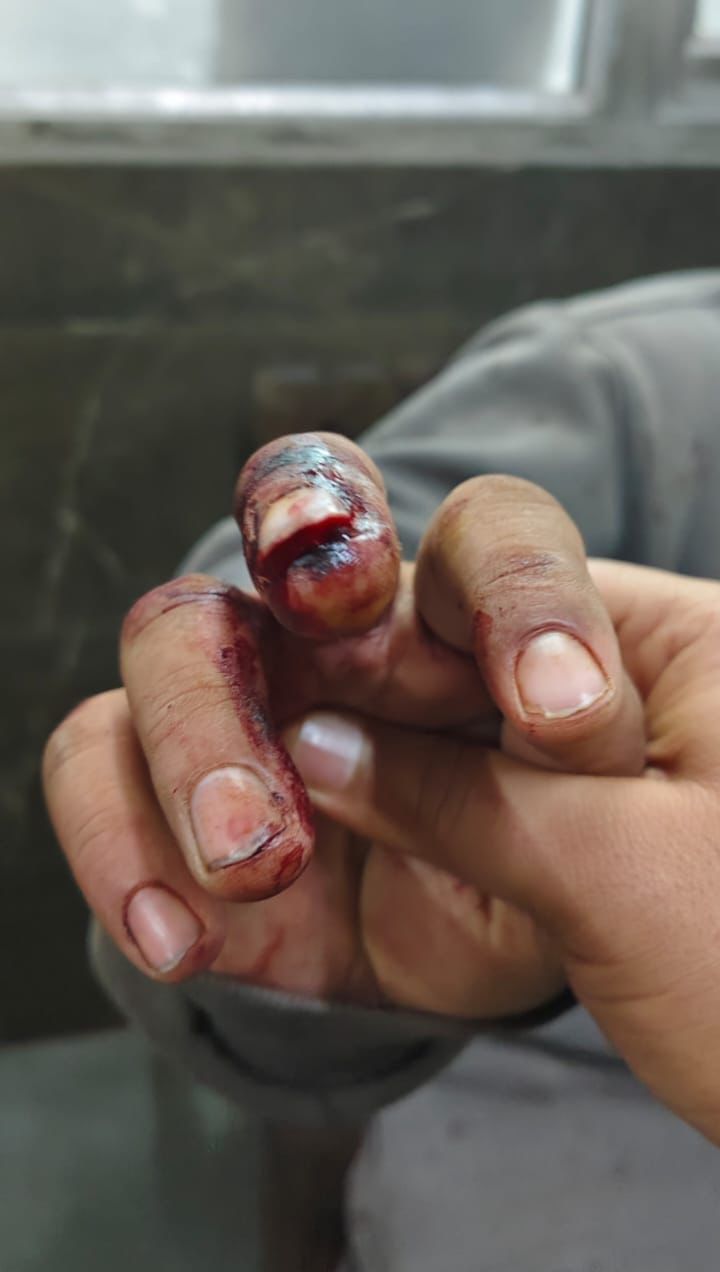 चालक की अंगुली का हाल